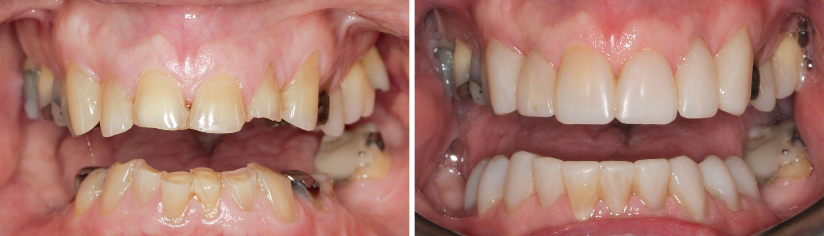 porcelain veneers
