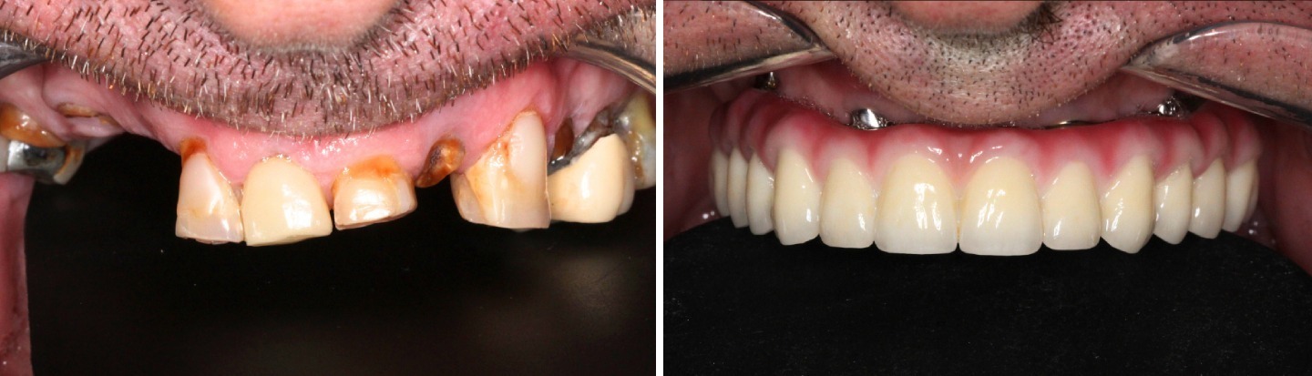 1 Jack before and after upper (1)