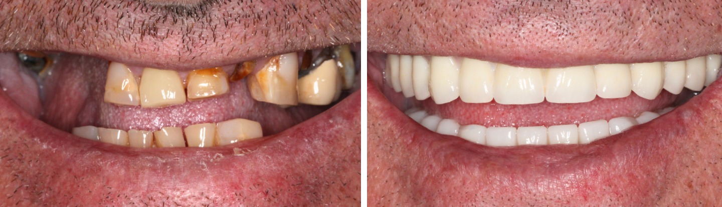 2 Jack before and after smile (1)