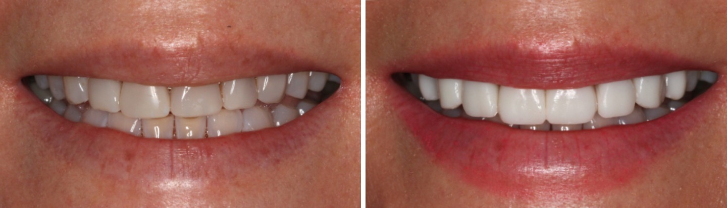 Gynette before and after smile