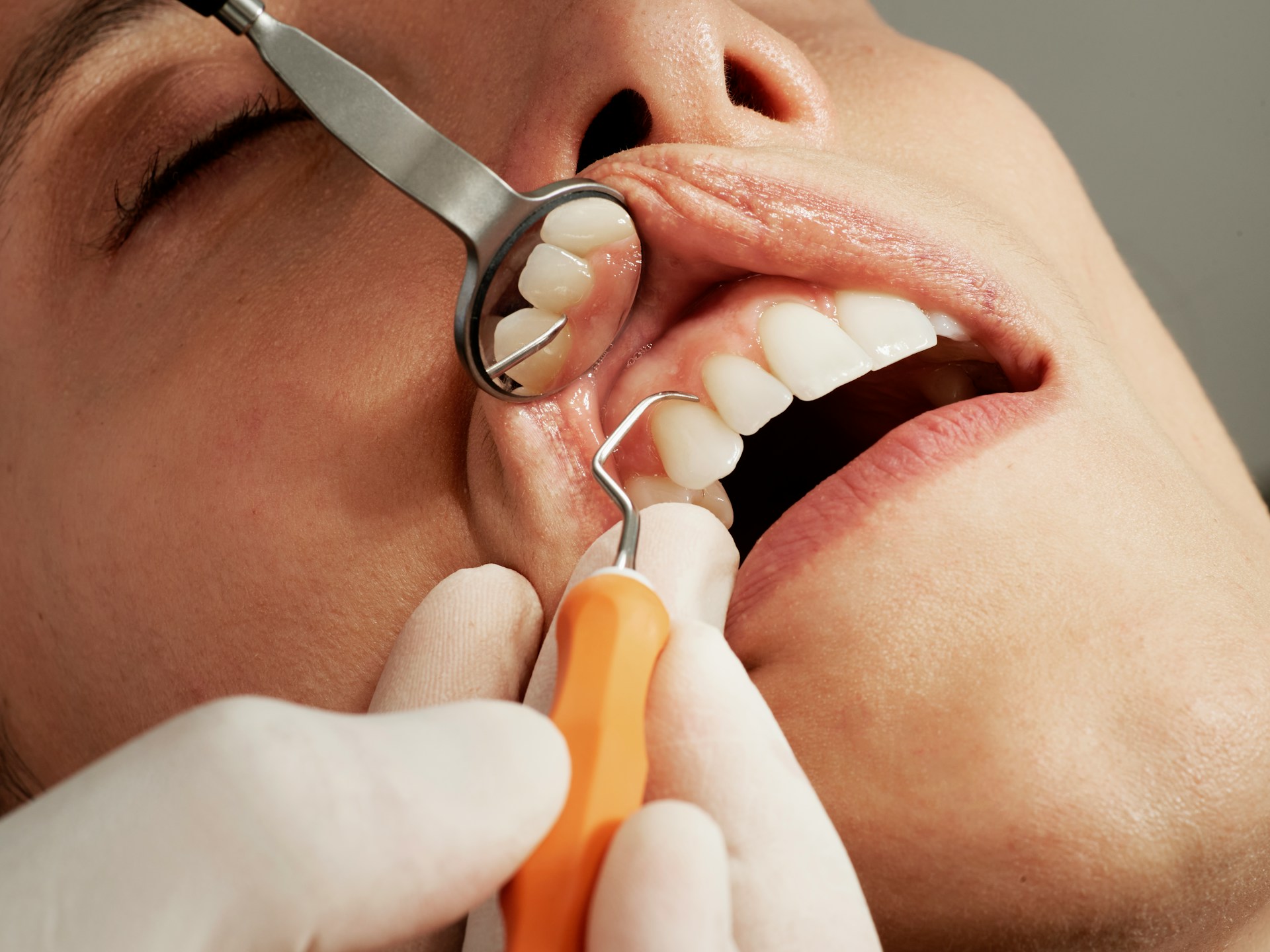 How Long Do Tooth Fillings Actually Last and What Should You Really Expect?